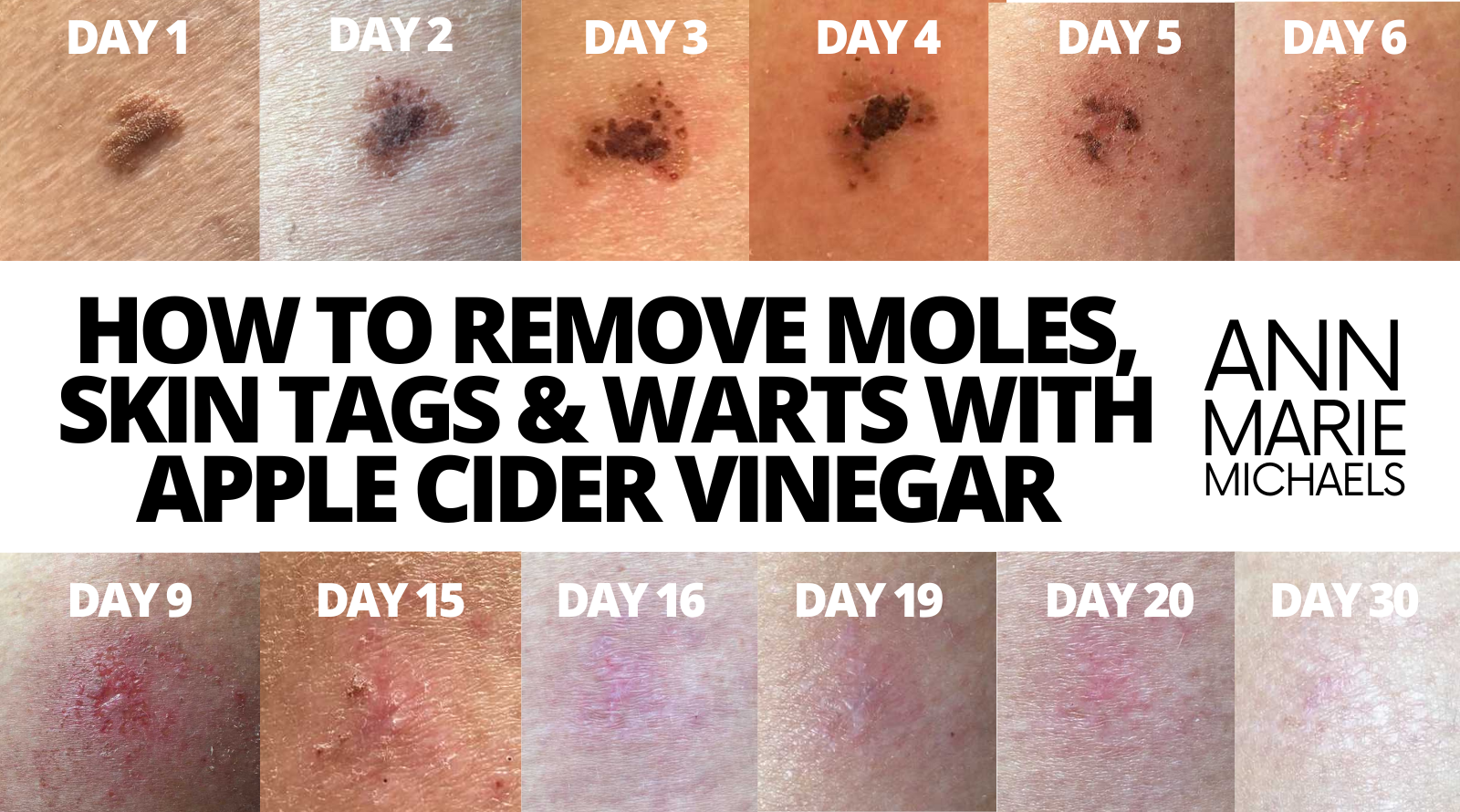 Remove Moles Warts and Skin Tags with Apple Cider Vinegar