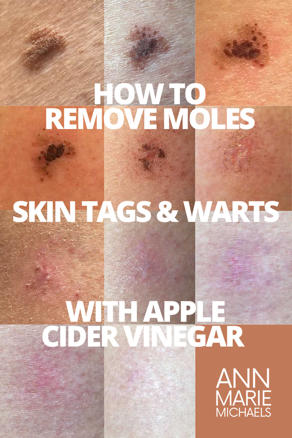 Remove Moles And Warts With Apple Cider Vinegar