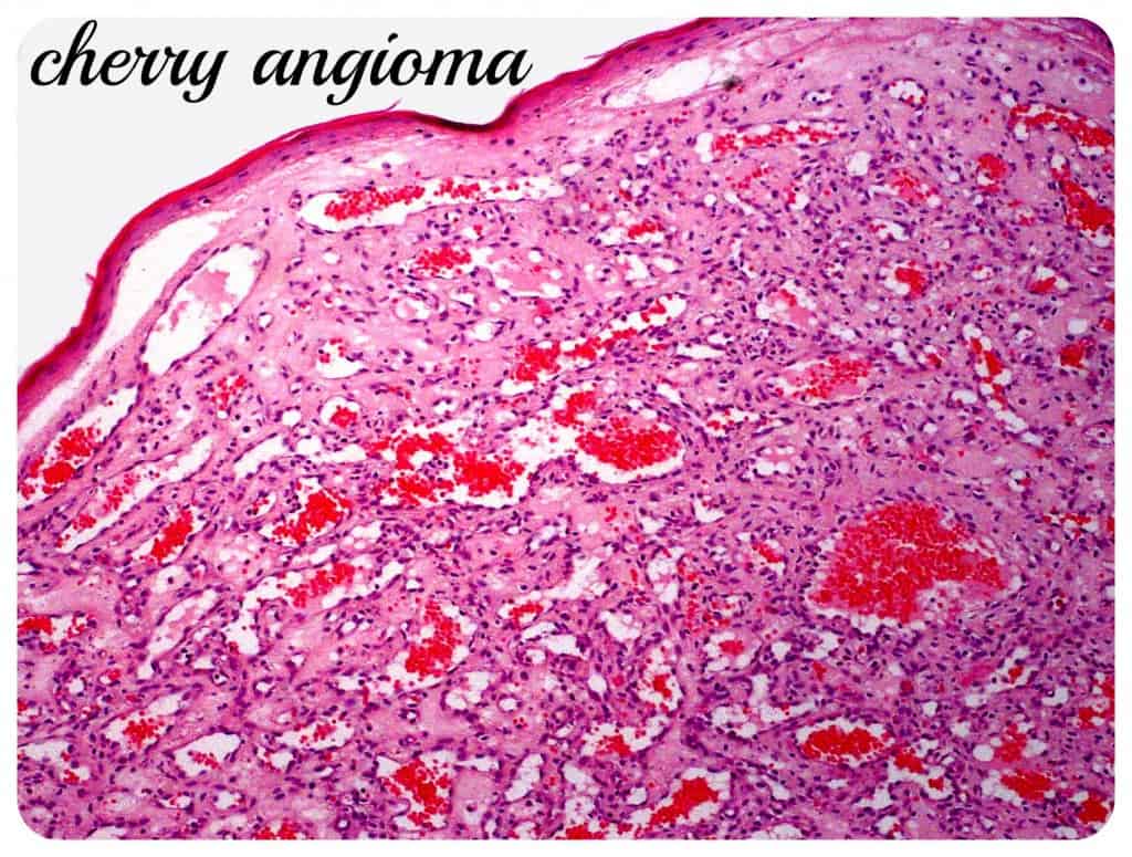 Cherry Angiomas, Iodine and Detoxing Bromide and Fluoride