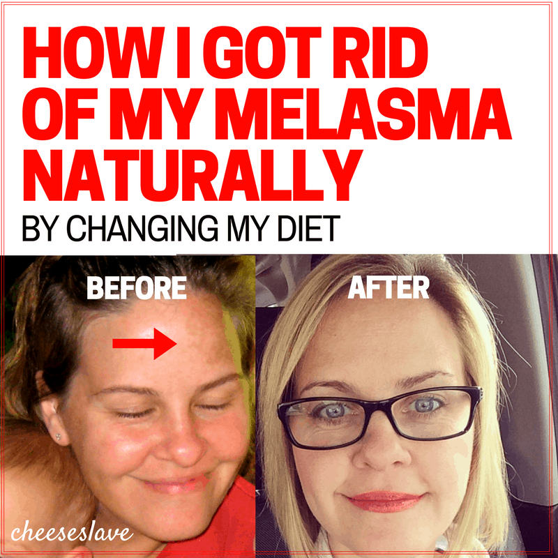 How I Got Rid of My Melasma Naturally